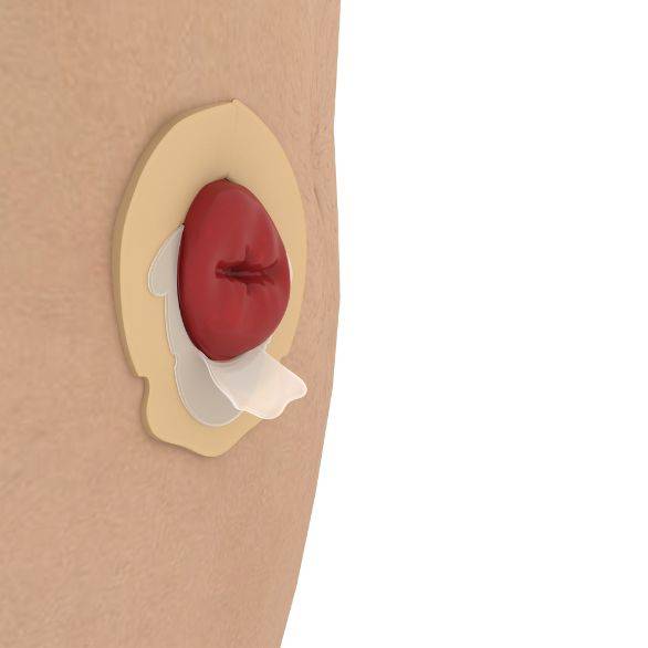 Ostoform Flowassist